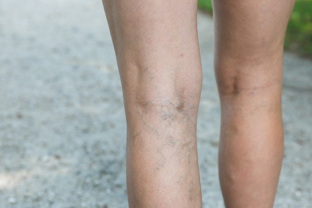 Varicose Veins on Legs