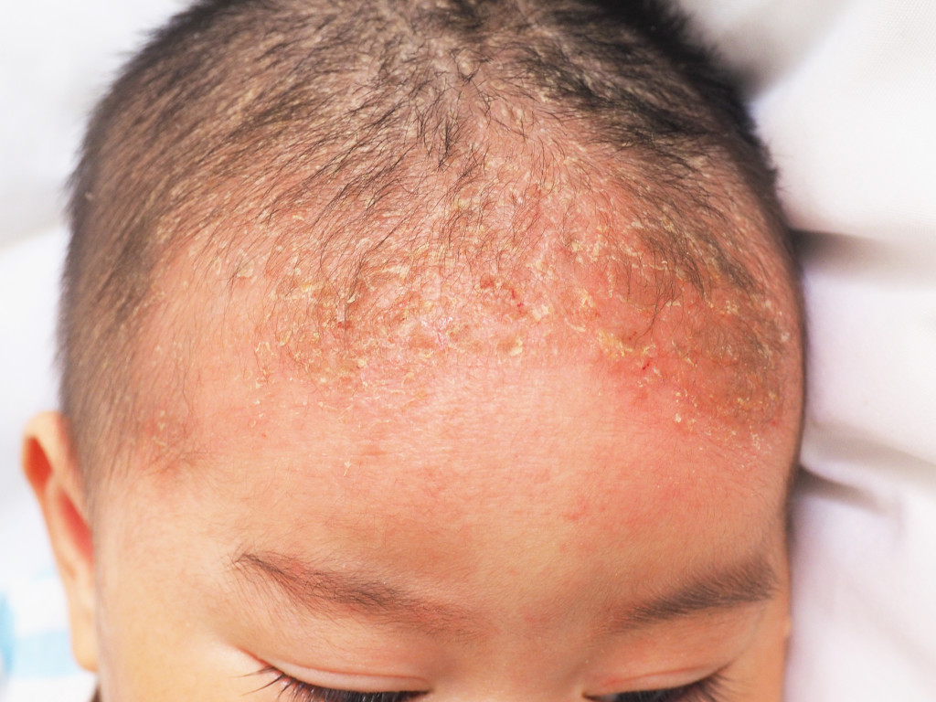 A child experiencing dermatitis