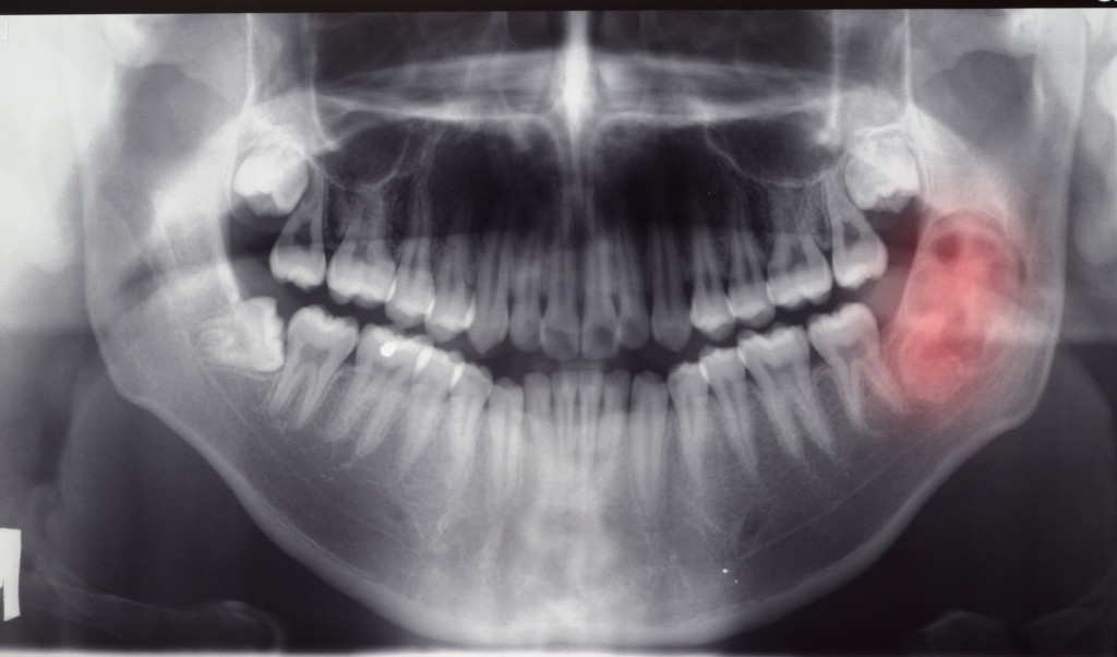 An x-ray showing an impacted wisdom tooth